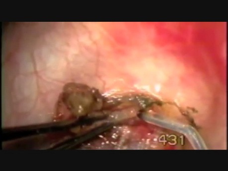 Dermoid Limbus Ablation with Fugo Blade