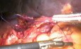 Laparoscopic splenectomy