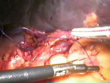 Laparoscopic splenectomy