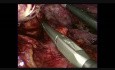 Hand Assisted Laparoscopic Splenectomy With Multiorgan Resection