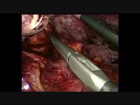 Hand Assisted Laparoscopic Splenectomy With Multiorgan Resection