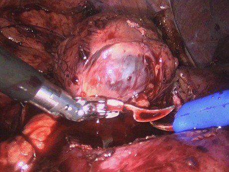 Robot Assisted Partial Nephrectomy with CMR Versius Robot