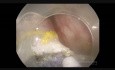 ESD of Large, Pedunculated Sigmoid Polyp. The Way to Cope with Big Vessels in the Stalk.