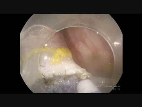 ESD of Large, Pedunculated Sigmoid Polyp. The Way to Cope with Big Vessels in the Stalk.