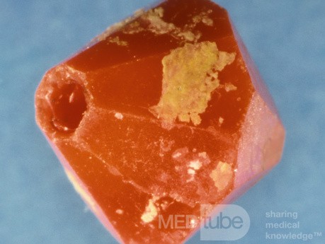 Inert Nasal Foreign Body