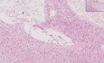 Cerebral Infarct, Recent