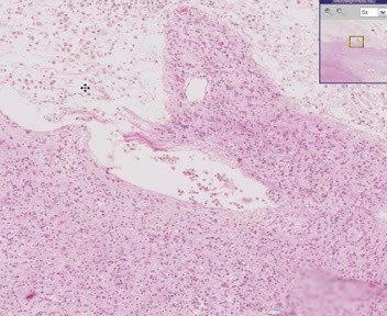 Cerebral Infarct, Recent