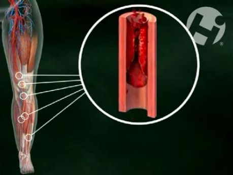 Blocked Blood Flow to the Lower Leg