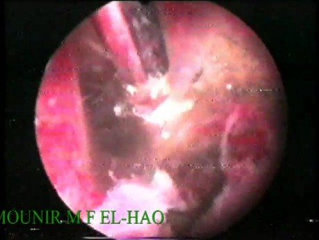 Treatment for Severe Intrauterine Adhesions by Use of Hysteroscopic Dissection
