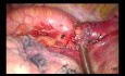 Upside Down Fissureless Technique for a Tumor Involving Fissure (Unedited Video)