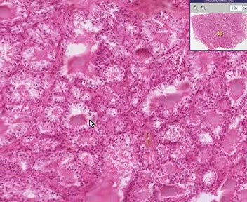 Thyroid - Graves Disease