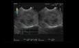  Endoscopic Ultrasound of Pancreatic Pseudopapillary Tumor
