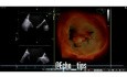 ECG - Mitral Valve Prolapse with Ruptured Chordae and Speckle Tracking Analysis of Left Ventricular Function
