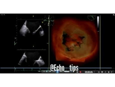 ECG - Mitral Valve Prolapse with Ruptured Chordae and Speckle Tracking Analysis of Left Ventricular Function